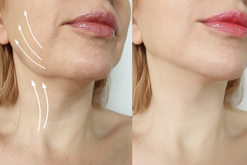 Facelift