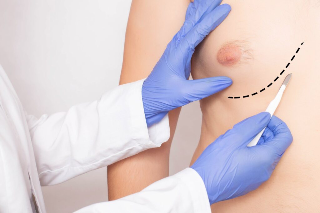 Gynecomasty