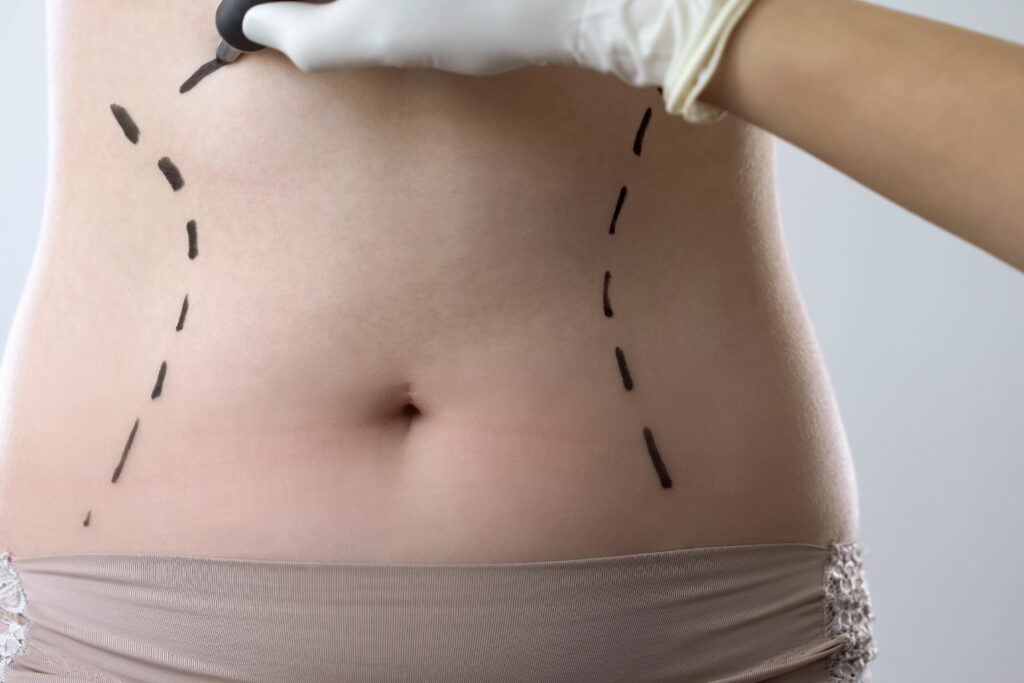 Abdominoplasty