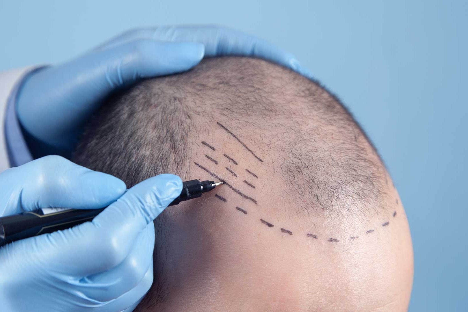 Hair Transplantation