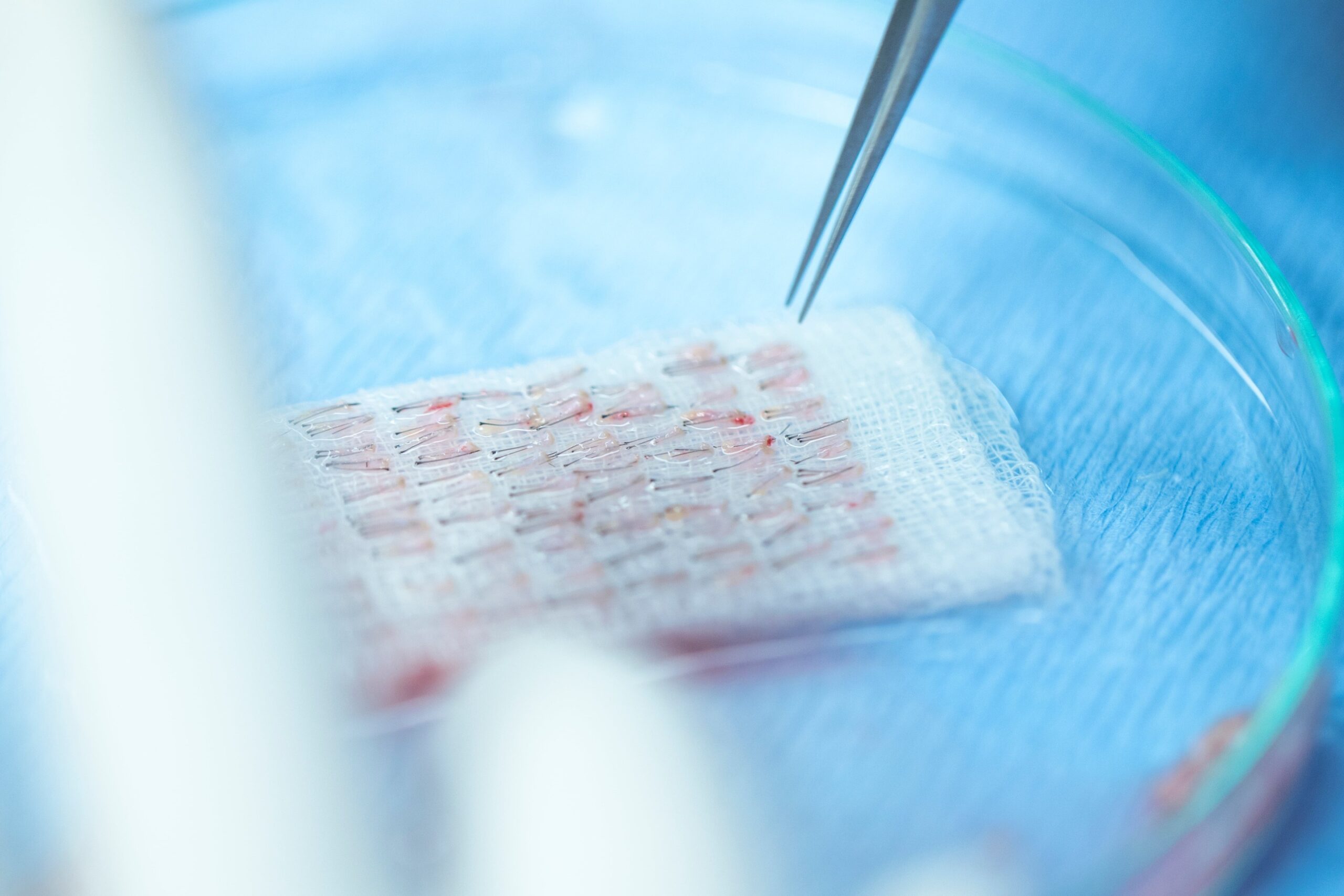 DHI Hair Transplantation
